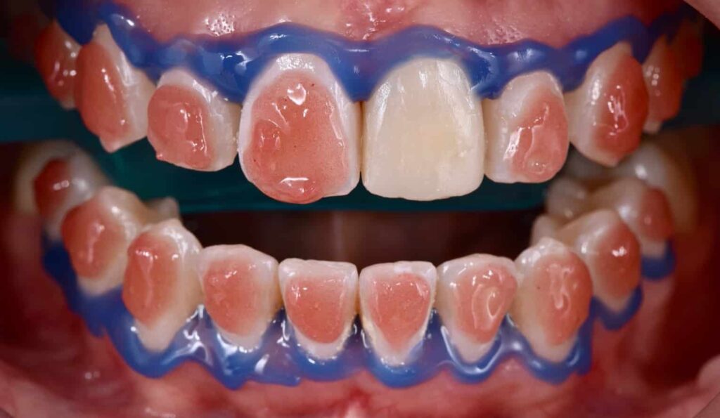 Captura-de-pantalla-2022-03-27-a-las-17.44.19 Blanqueamiento dental - Oh My Dent