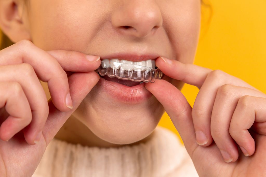 Foto-22-1024x683 Blanqueamiento Dental Casero Oh My Dent
